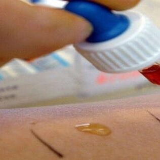 Allergy Testing and Vaccine