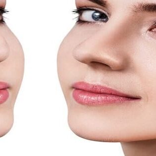 Rhinoplasty