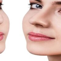Rhinoplastie