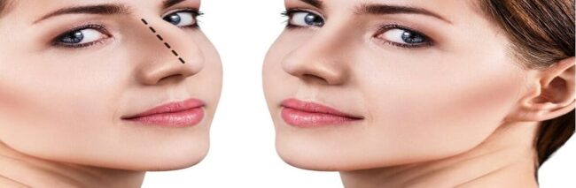 Rhinoplastie