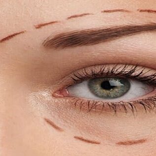 Eyelid Aesthetics