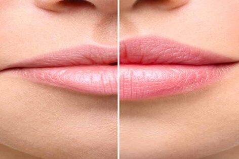 Lip Lift Lip Lift