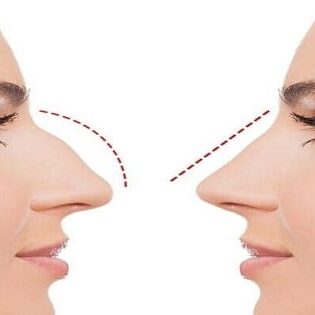 Piezo Rhinoplasty Piezo Rhinoplasty