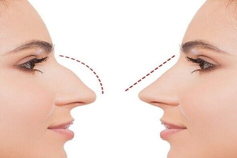 Piezo Rhinoplasty