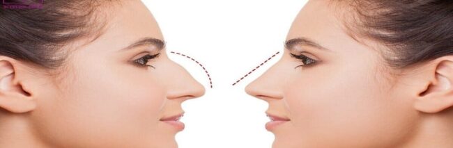 Piezo Rhinoplasty