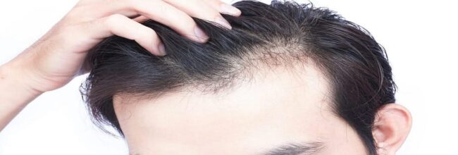 Hair Loss Treatments