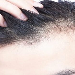 Traitements contre la perte de cheveux Traitements contre la perte de cheveux