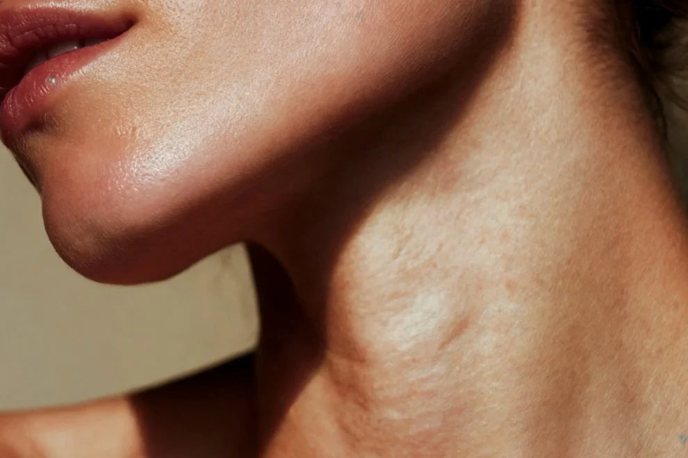Gıdı (Boyun) Liposuction Gıdı (Boyun) Liposuction